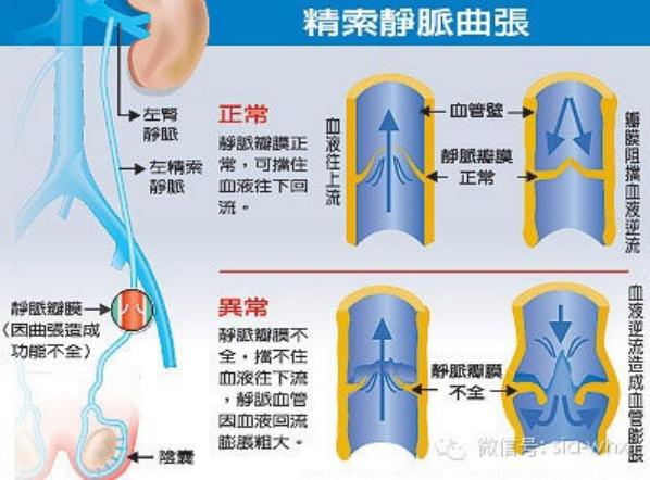 關(guān)于2021年征兵精索靜脈曲張標(biāo)準(zhǔn)的探討，2021年征兵精索靜脈曲張標(biāo)準(zhǔn)深度解析